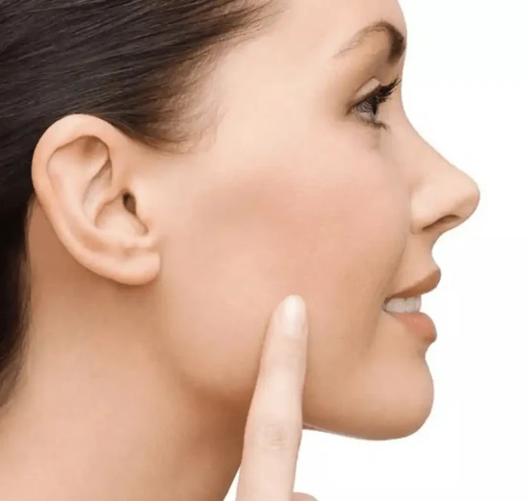 Bichectomía - Dra. Irene Arellano