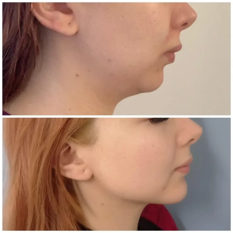 Mentoplastía - Dra. Irene Arellano