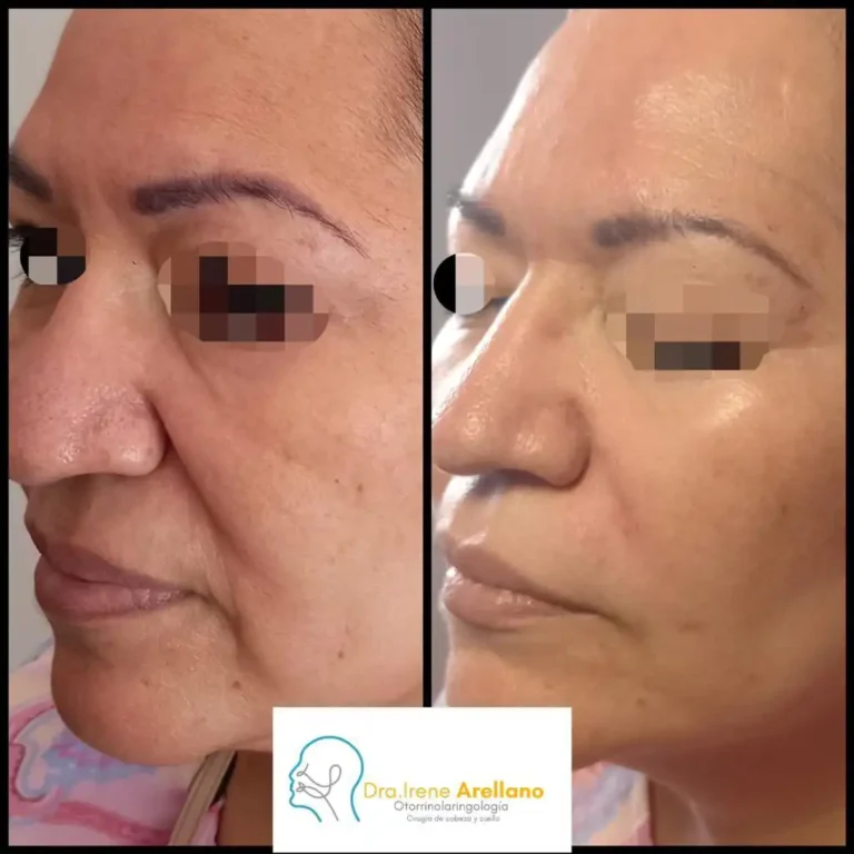 Rejuvenecimiento Facial - Dra. Irene Arellano