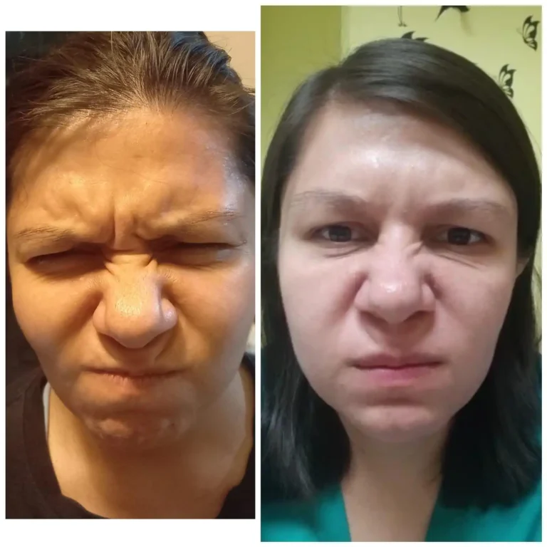 Rejuvenecimiento Facial - Dra. Irene Arellano